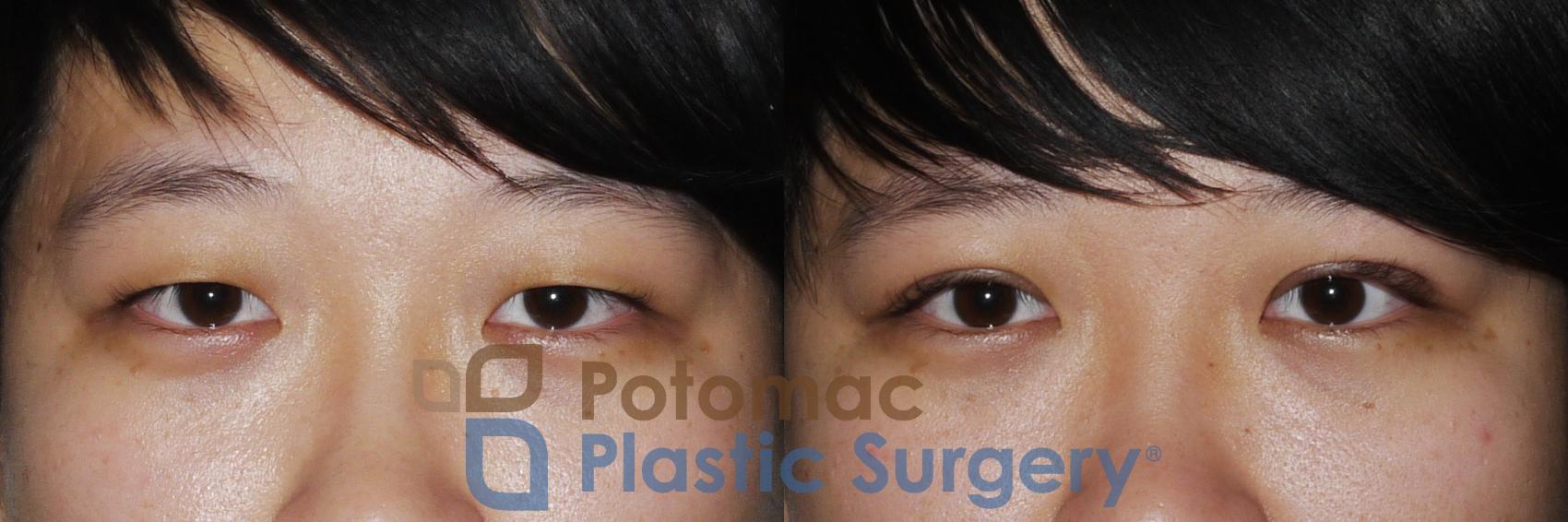 Before & After Asian Eyelid Surgery Case 159 Front View in Washington DC & Arlington , DC