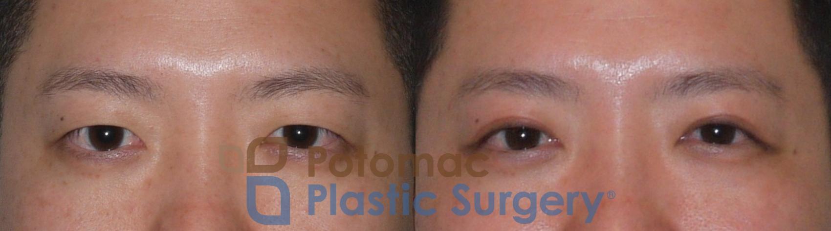 Before & After Asian Eyelid Surgery Case 95 Front View in Washington DC & Arlington , DC