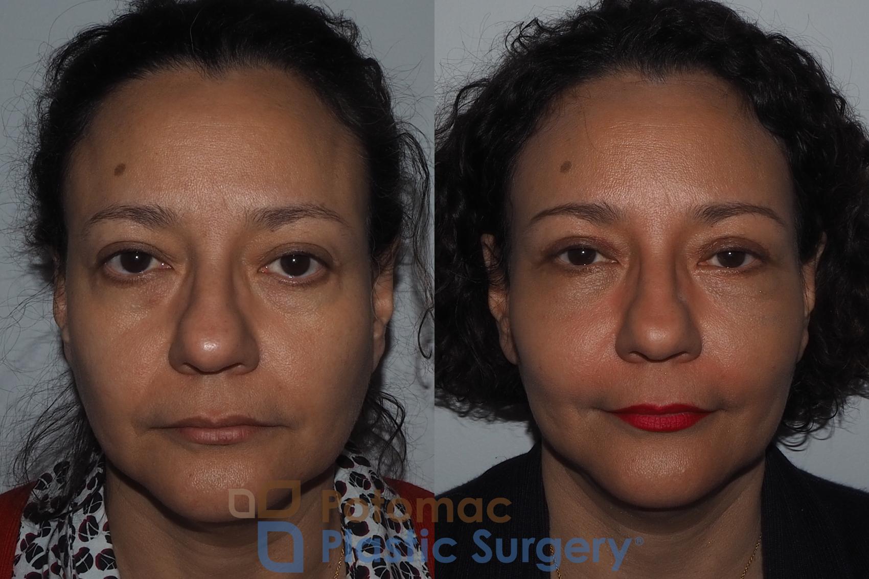 Before & After Blepharoplasty Case 218 Front View in Washington DC & Arlington , DC