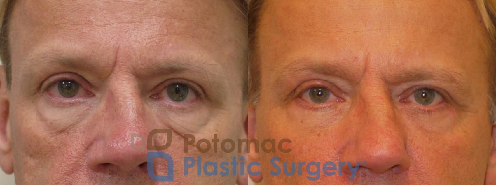 Before & After Blepharoplasty Case 260 Front Close-Up  View in Washington DC & Arlington , DC