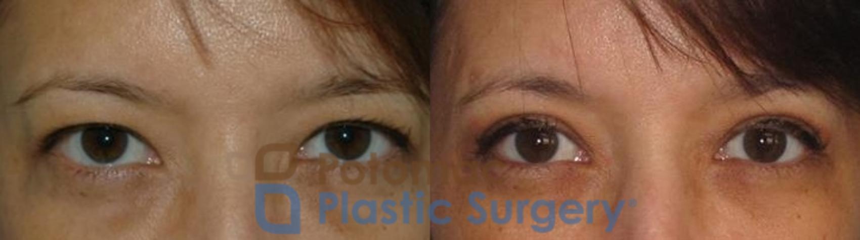 Before & After Blepharoplasty (Eyelid Surgery) Case 275 Front View in Washington DC & Arlington , DC