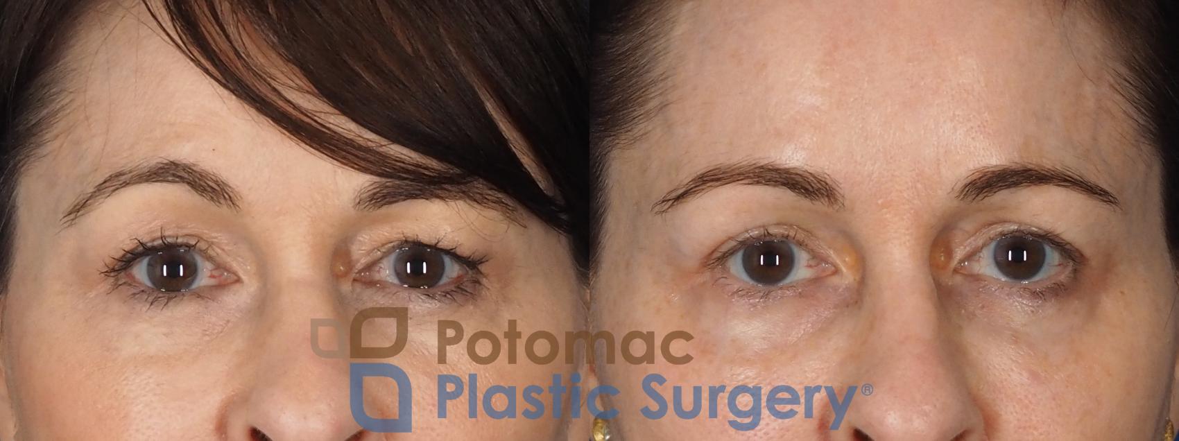 Before & After Blepharoplasty (Eyelid Surgery) Case 343 Front View in Washington DC & Arlington , DC