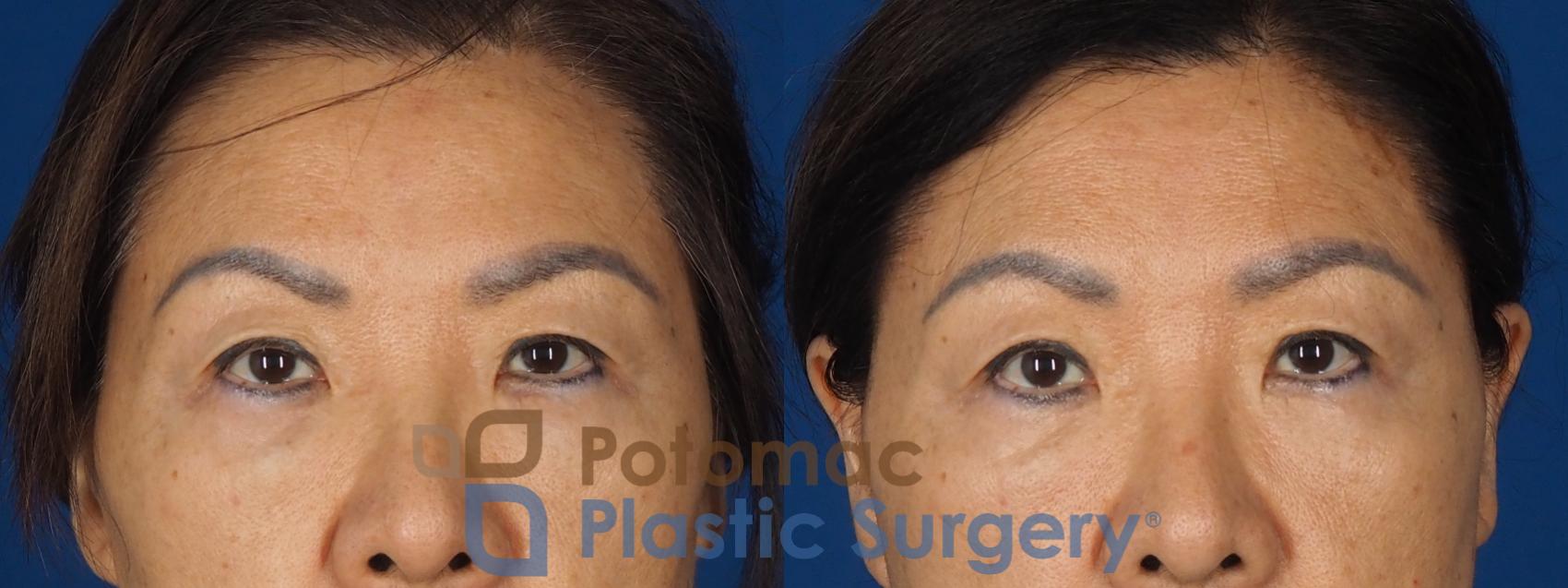 Before & After Blepharoplasty (Eyelid Surgery) Case 347 Front View in Washington DC & Arlington , DC