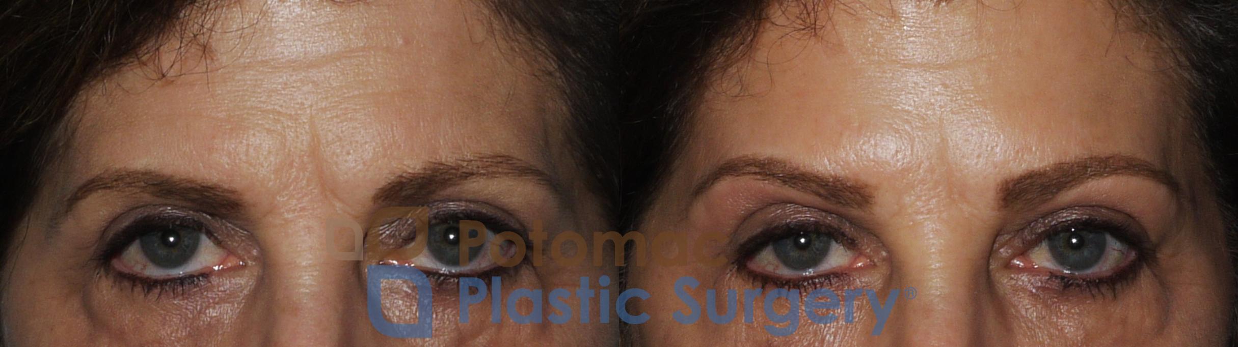 Before & After Botox Cosmetic Case 188 View #1 View in Washington, DC