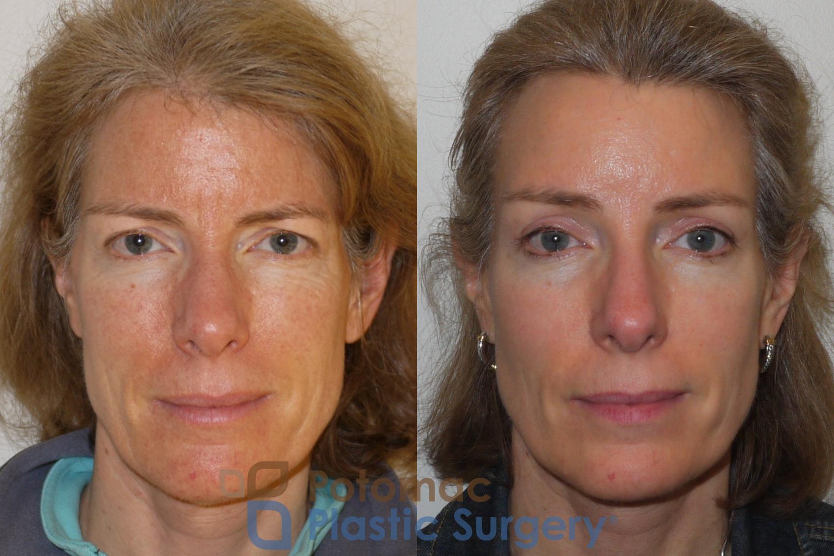 Before & After Brow Lift Case 102 Front View in Washington DC & Arlington , DC