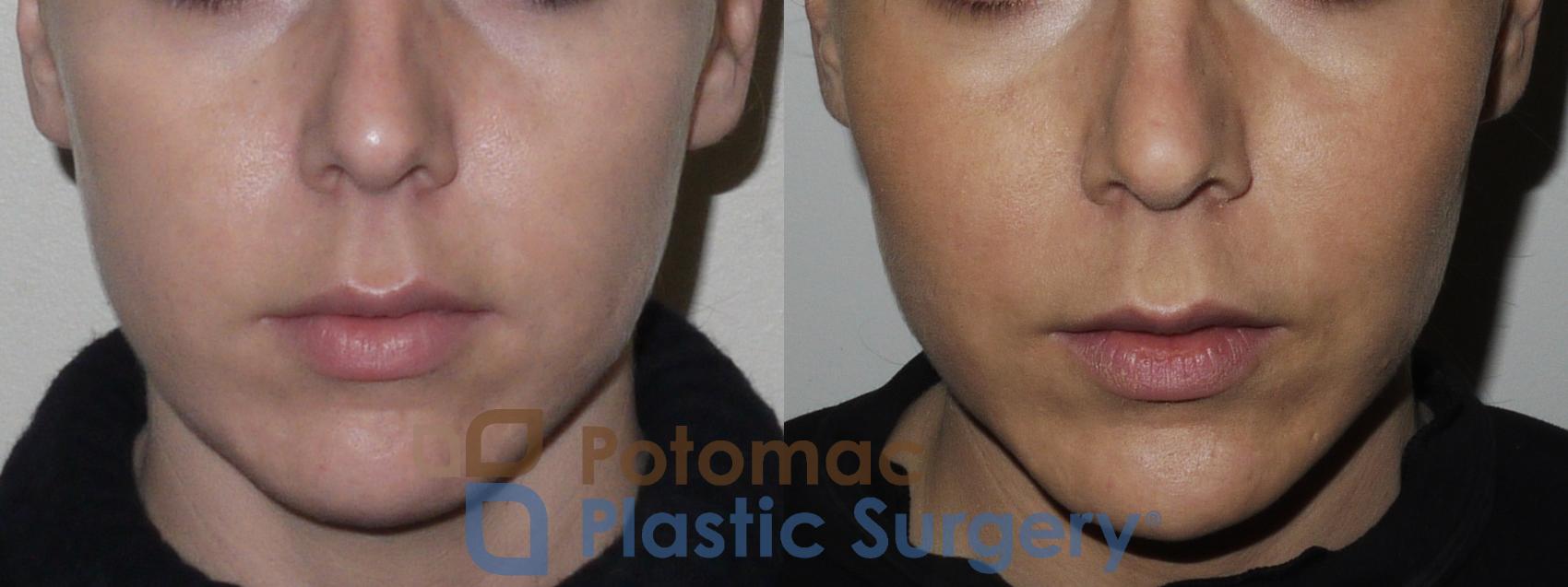 Before & After Cheek Augmentation Case 162 Front View in Washington DC & Arlington , DC