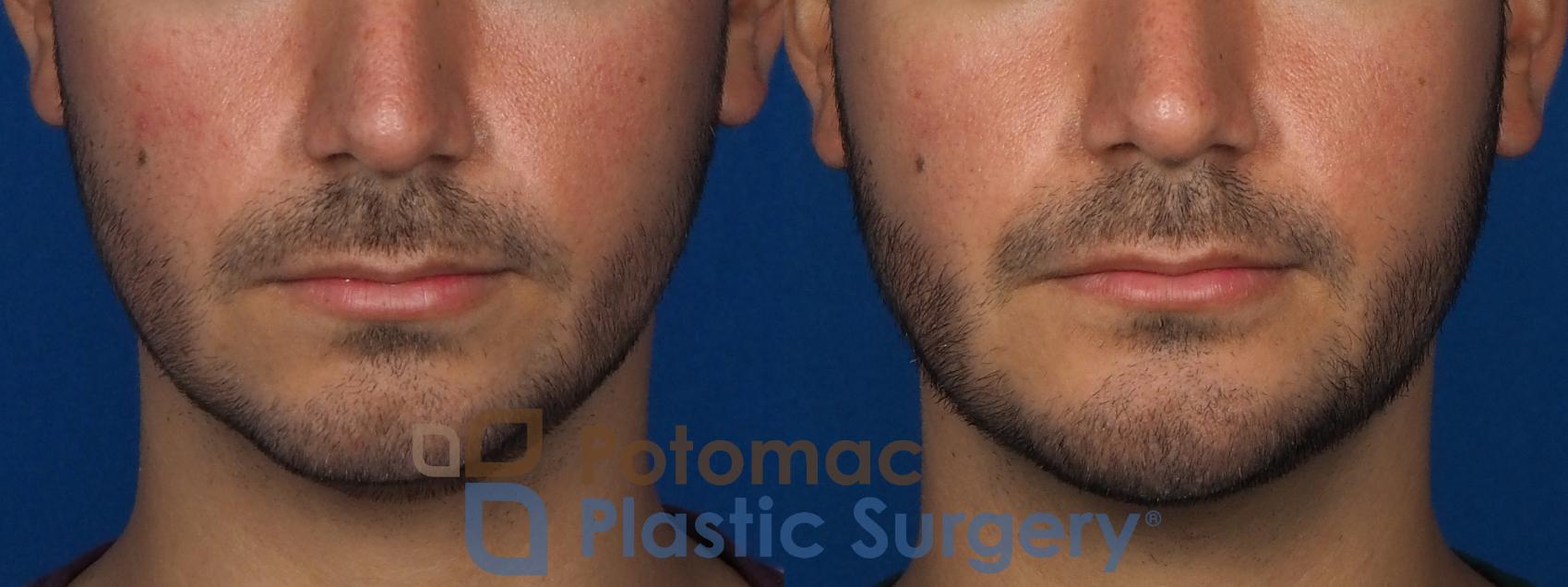 Before & After Chin Augmentation Case 233 Front View in Washington DC & Arlington , DC