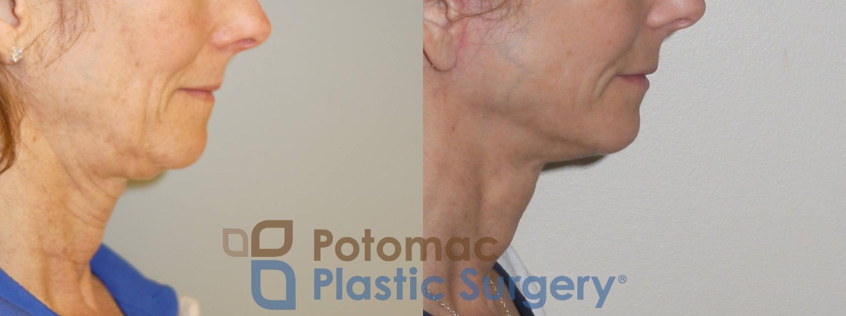 Before & After Facelift Case 100 Right Side View in Washington DC & Arlington , DC
