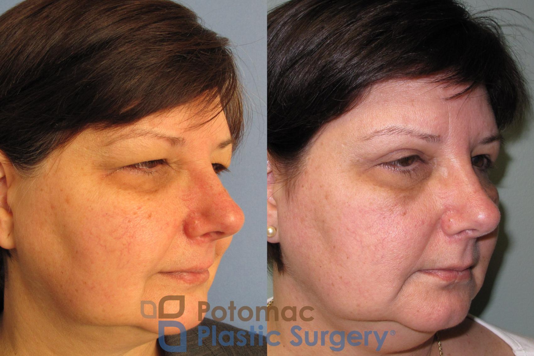 Before & After Facelift Case 2 Right Oblique View in Washington DC & Arlington , DC