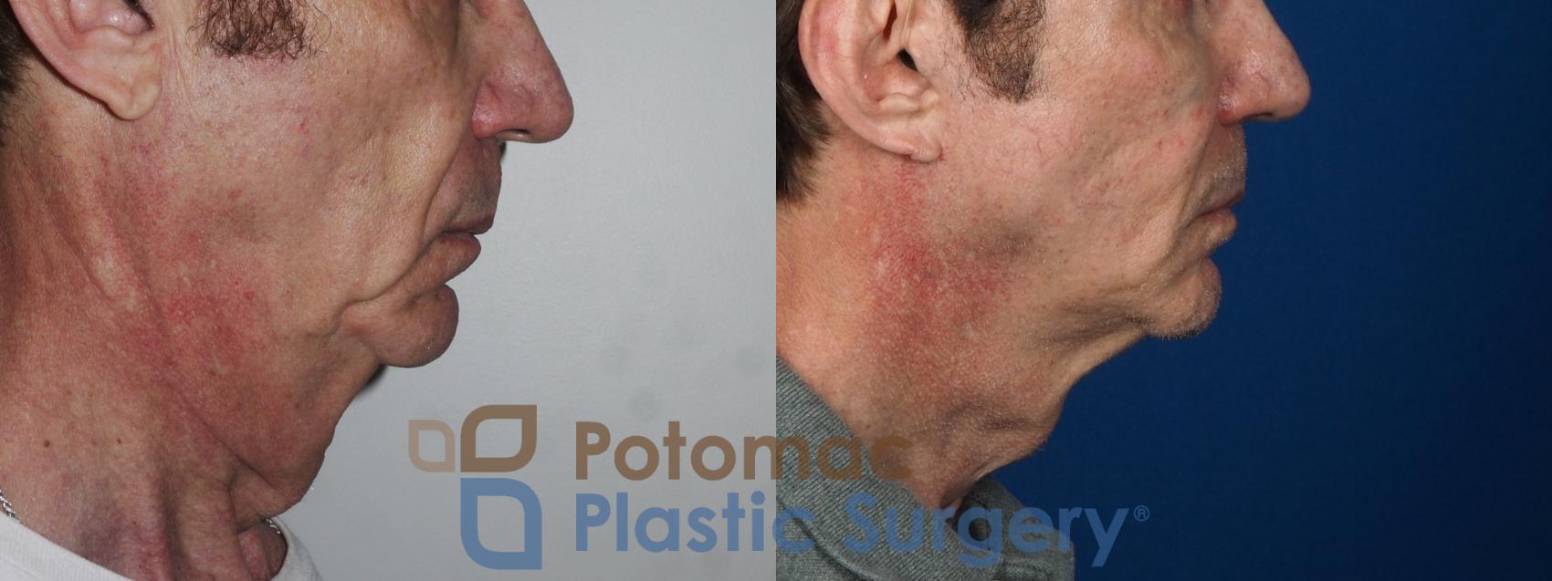 Before & After Facelift Case 225 Right Side View in Washington DC & Arlington , DC