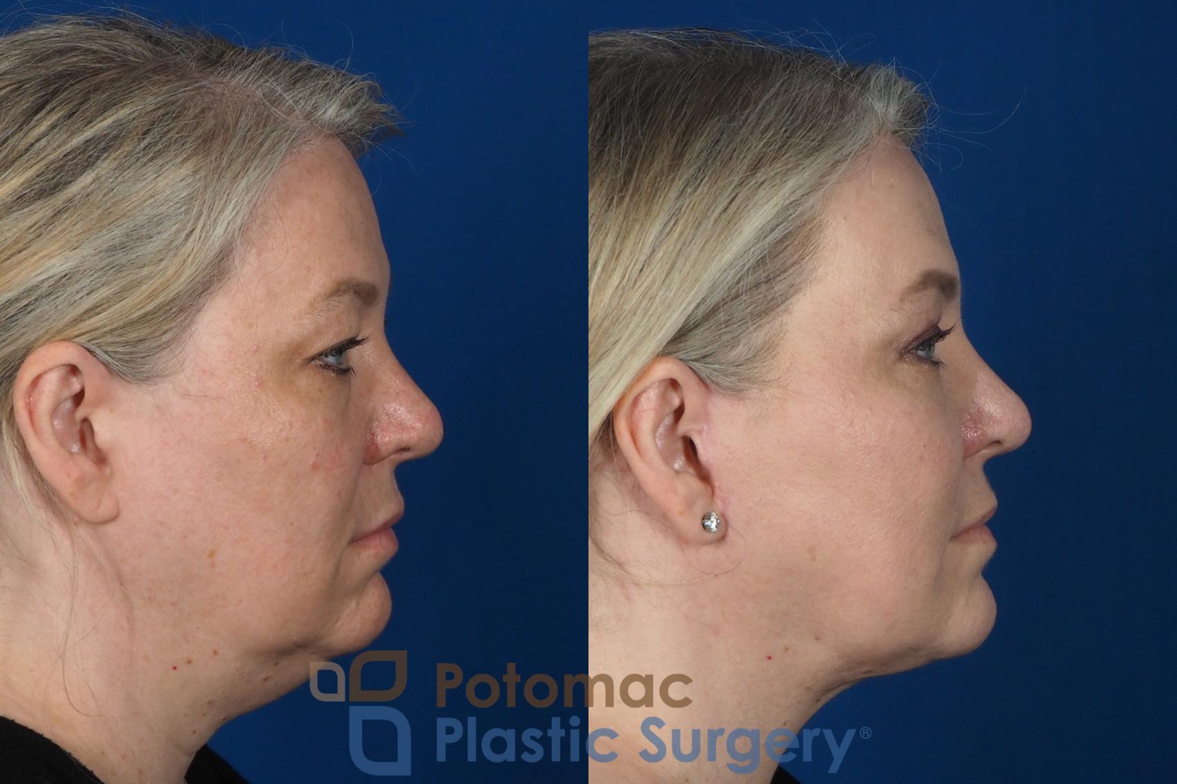 Before & After Facelift Case 252 Right Side View in Washington DC & Arlington , DC