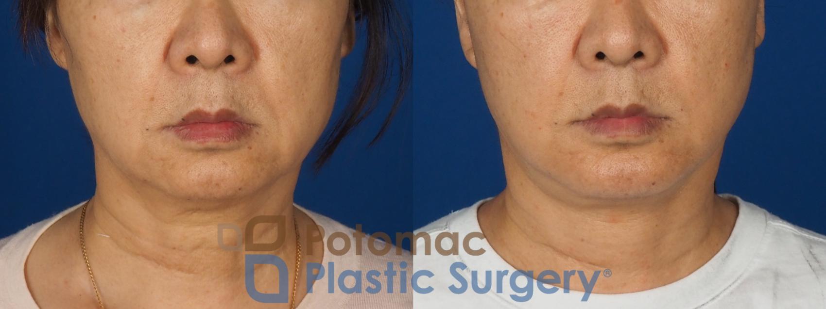 Before & After Neck Lift Case 350 Front View in Washington DC & Arlington , DC