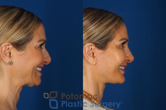 Before & After Facelift Case 362 Right - Smiling View in Washington DC & Arlington , DC