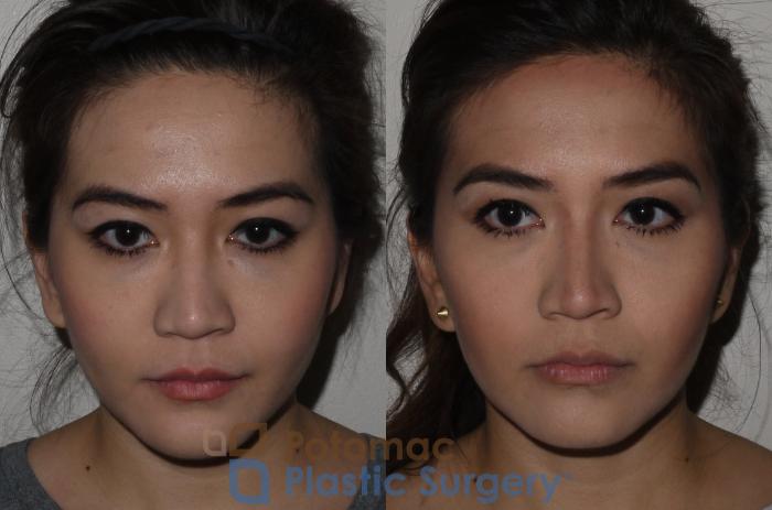 Before & After Botox Cosmetic Case 122 Front View in Washington DC & Arlington , DC