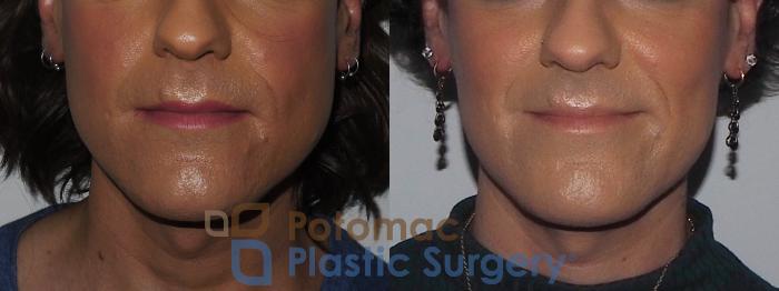 Before & After Botox Cosmetic Case 224 Front View in Washington DC & Arlington , DC