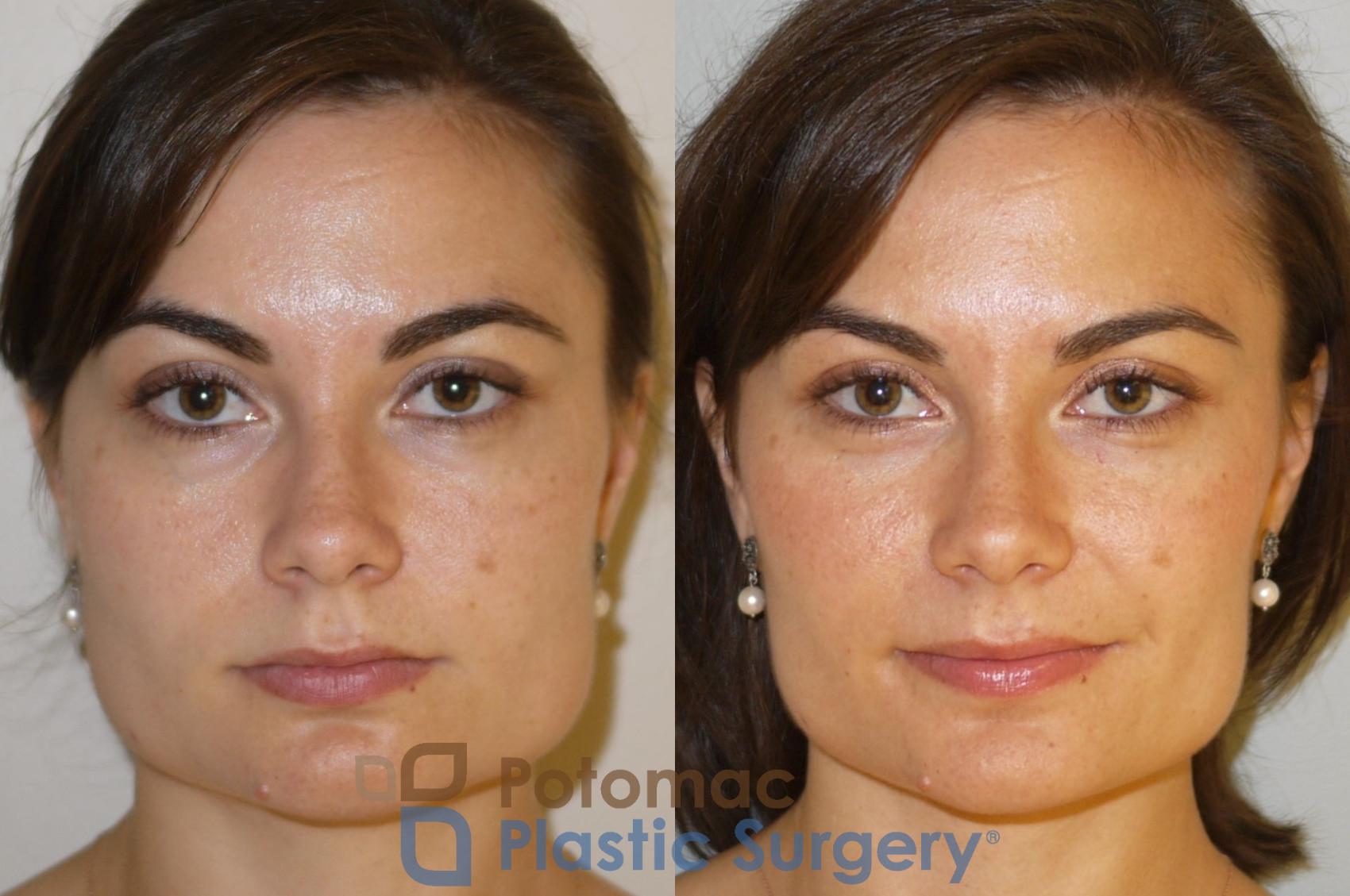 Before & After Facial Sculpting Case 85 Front View in Washington DC & Arlington , DC