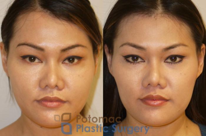 Before & After Botox Cosmetic Case 93 Front View in Washington DC & Arlington , DC