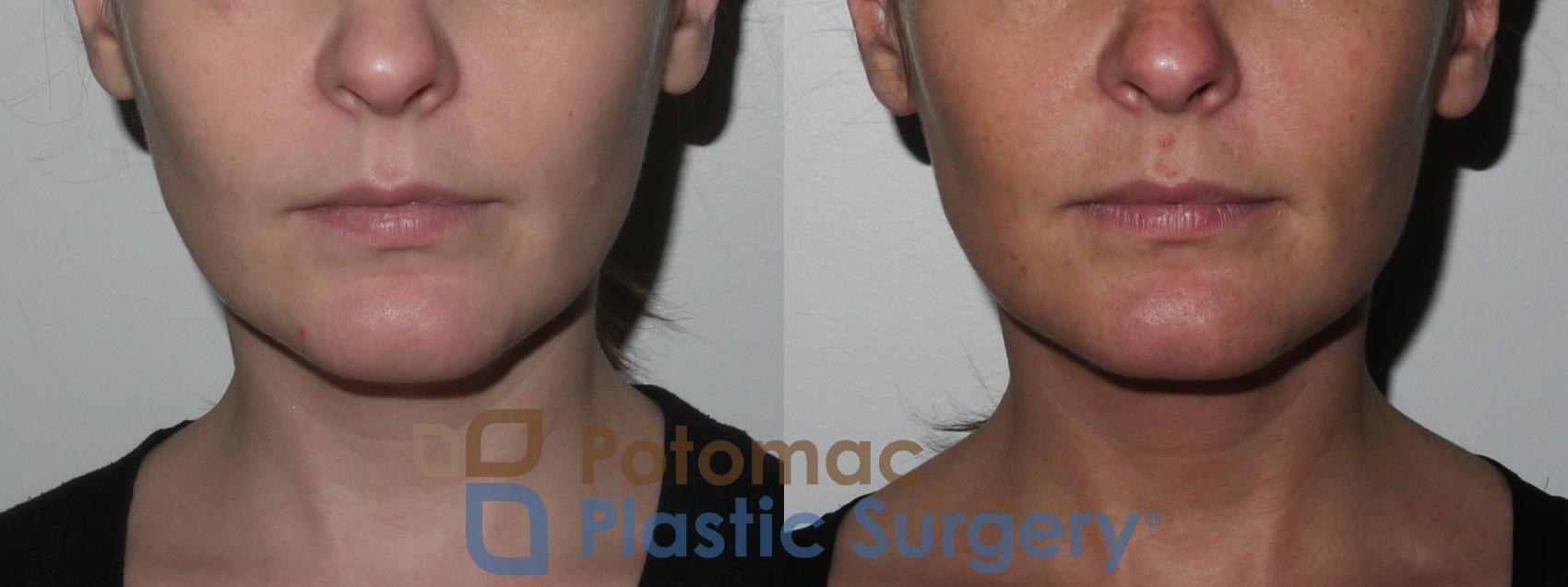 Before & After Kybella Case 151 Front View in Washington DC & Arlington , DC