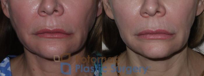 Before & After Botox Cosmetic Case 124 Front View in Washington DC & Arlington , DC