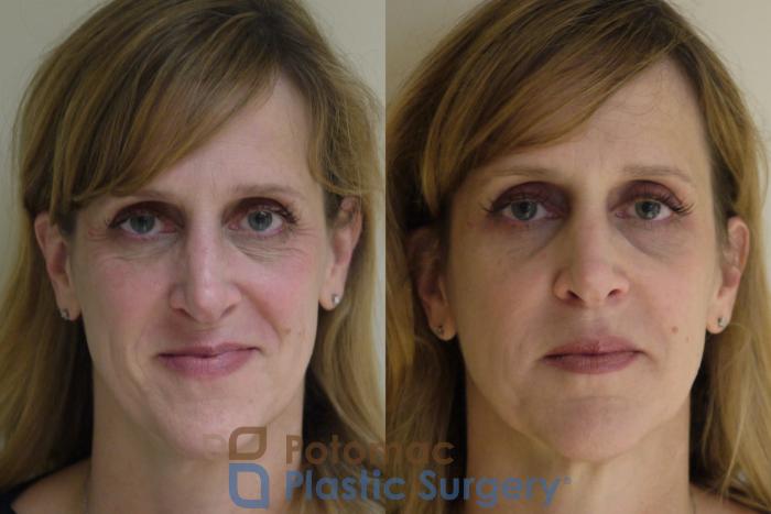 Before & After Botox Cosmetic Case 138 Front View in Washington DC & Arlington , DC