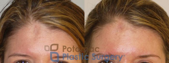 Before & After Botox Cosmetic Case 191 Front View in Washington DC & Arlington , DC