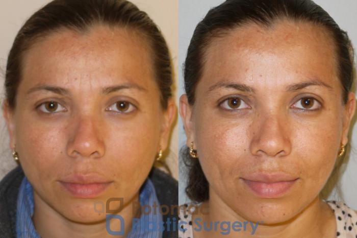 Before & After Botox Cosmetic Case 53 Front View #1 View in Washington DC & Arlington , DC