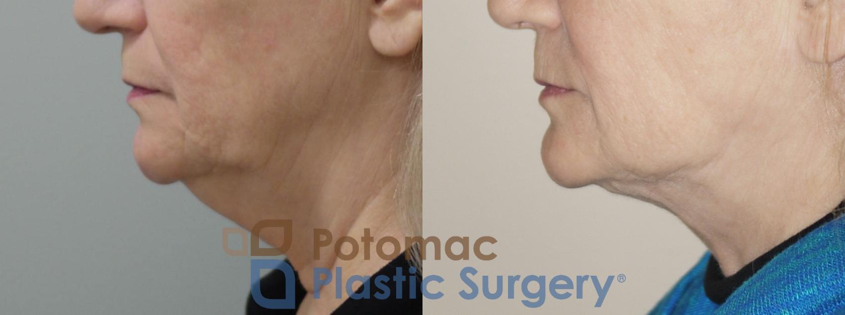 Before & After Neck Lift Case 89 View #3 View in Washington DC & Arlington , DC