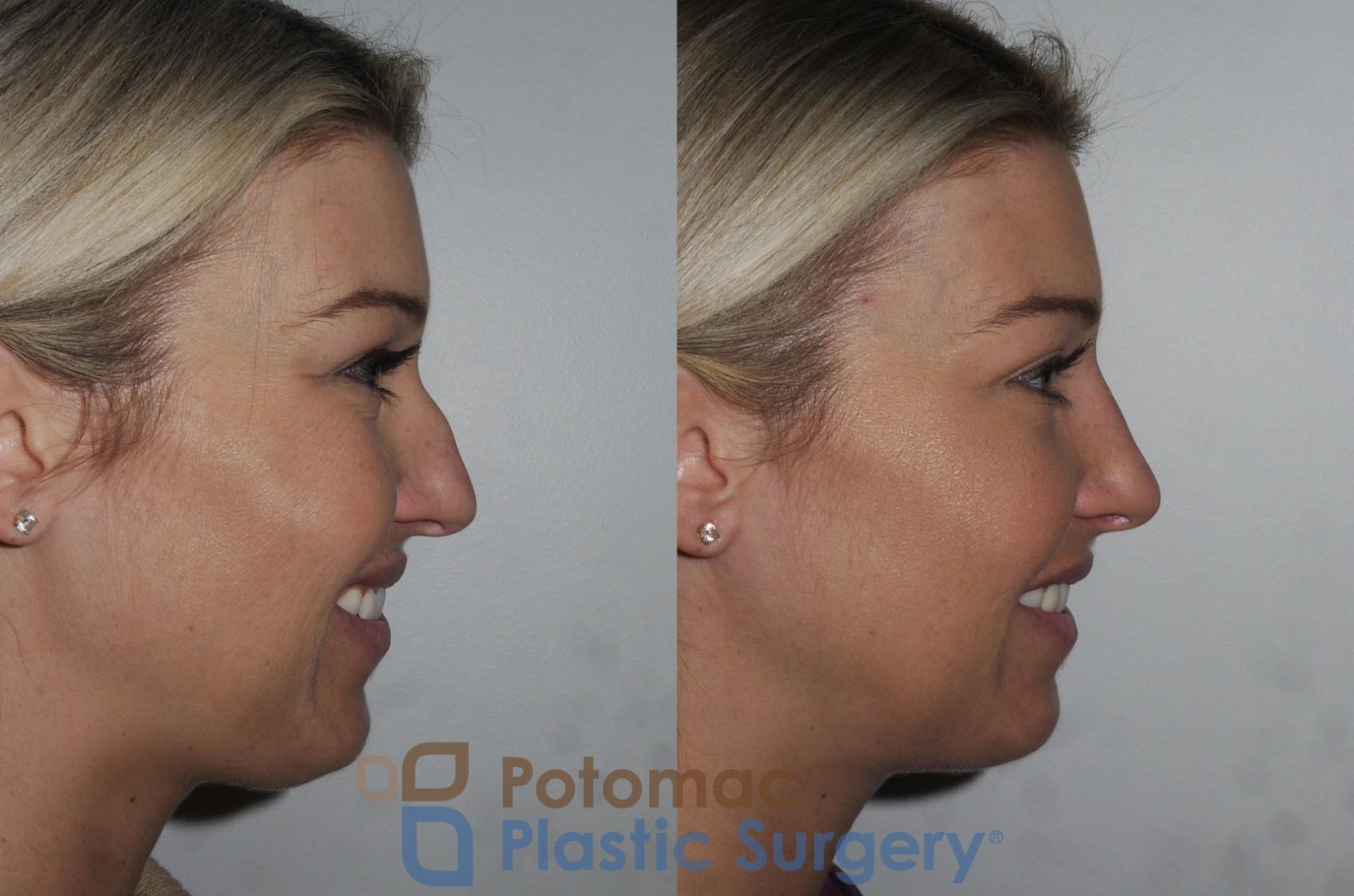 Rhinoplasty And Sinus Surgery To Balance The Shape And Function Of The