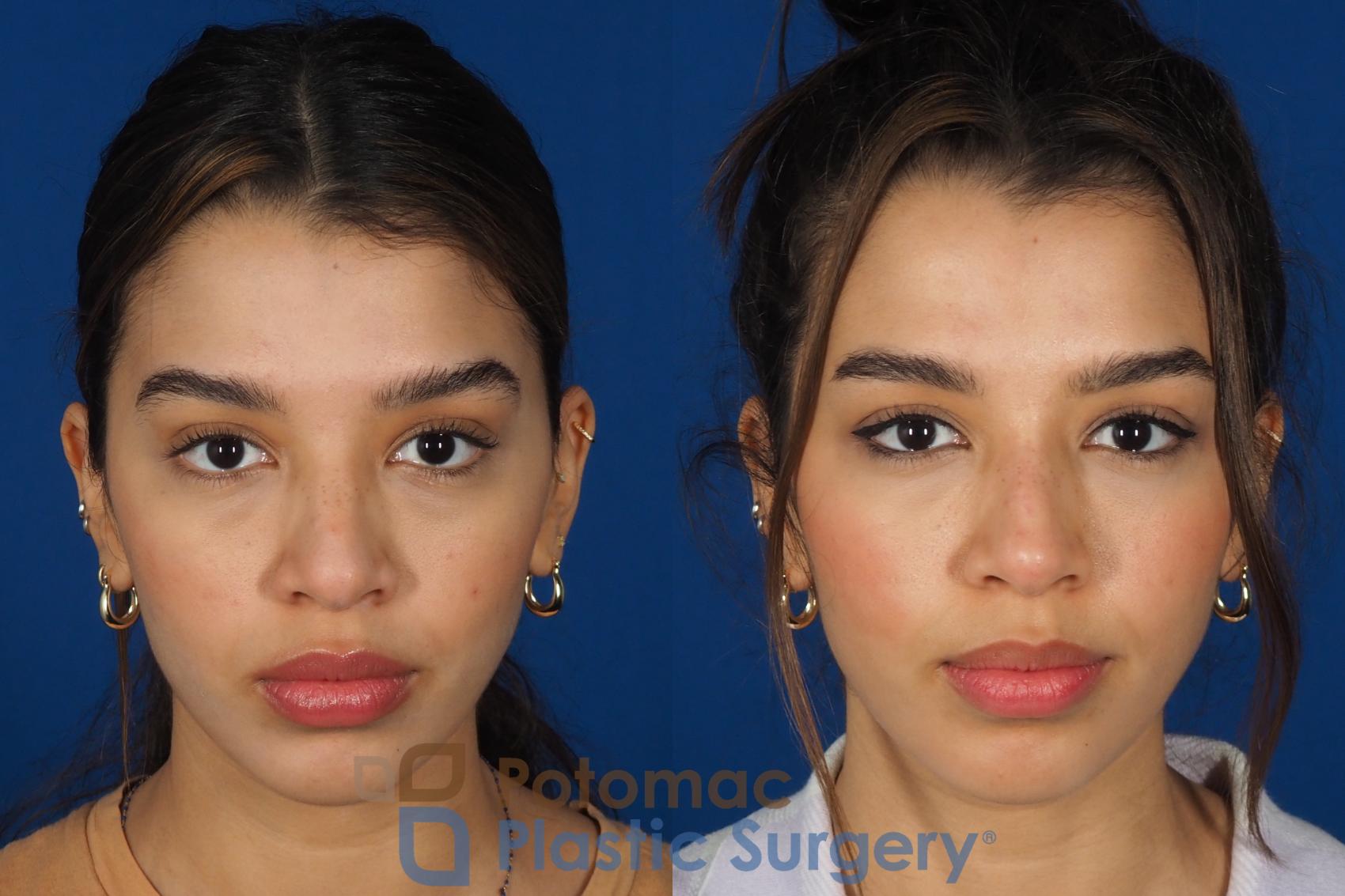 Before & After Rhinoplasty - Cosmetic Case 288 Front View in Washington DC & Arlington , DC