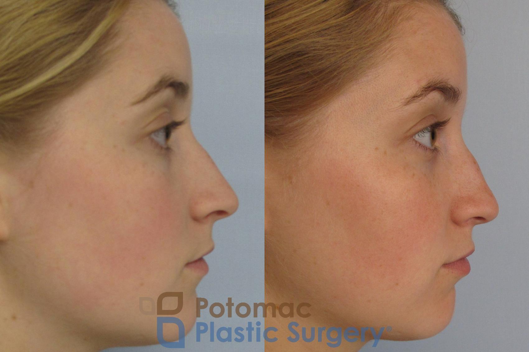 Before & After Rhinoplasty - Cosmetic Case 4 Right Side View in Washington, DC