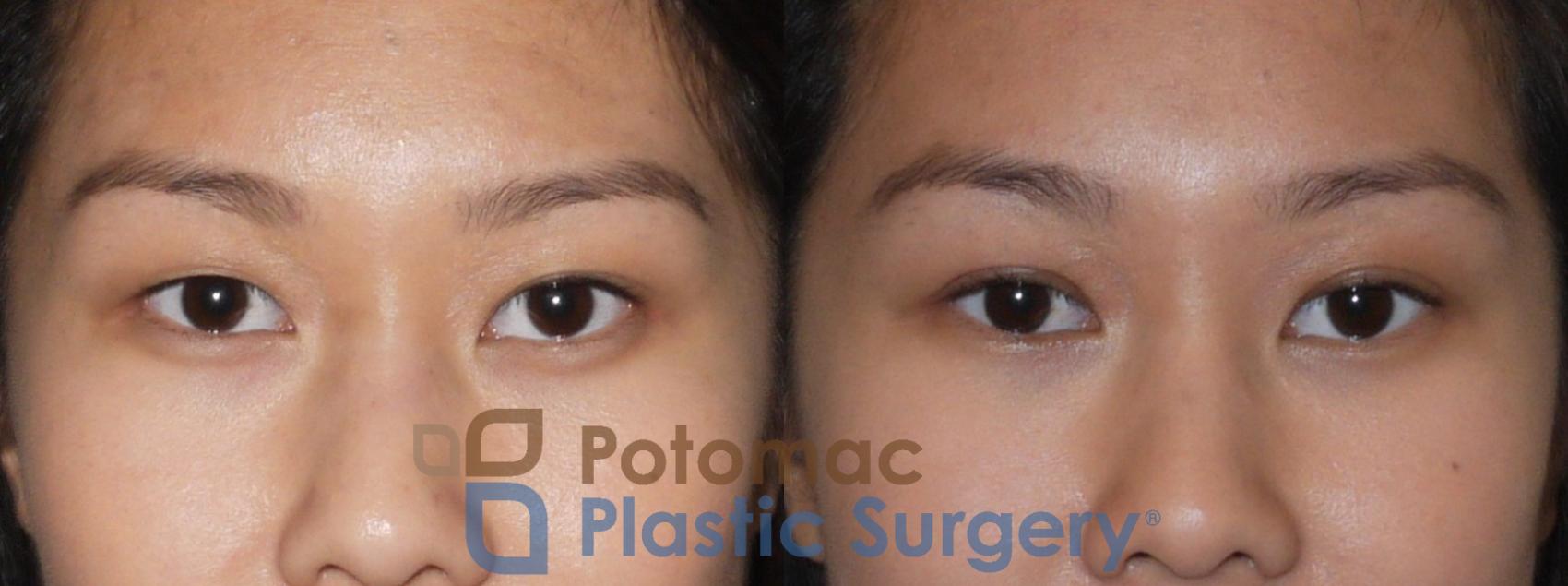 Before & After Asian Eyelid Surgery Case 109 Front Close-Up View #1 View in Washington, DC