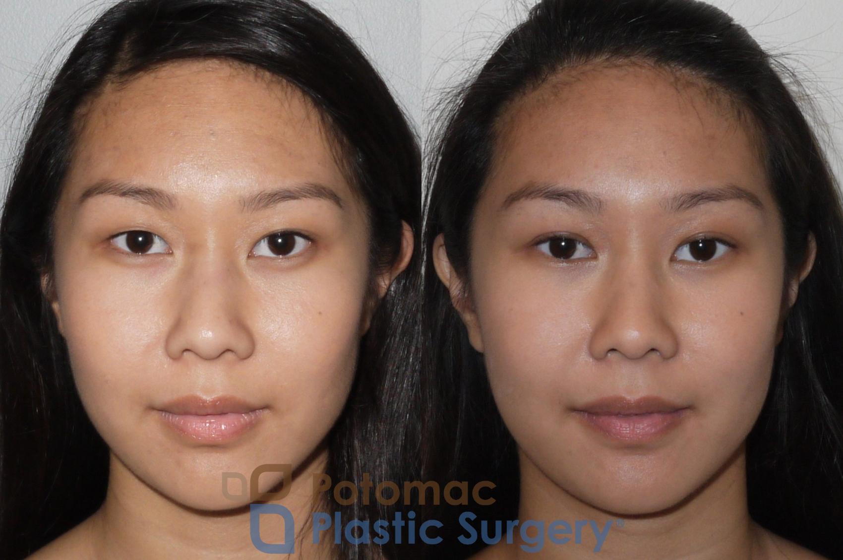 Before & After Asian Eyelid Surgery Case 109 Front View in Washington, DC