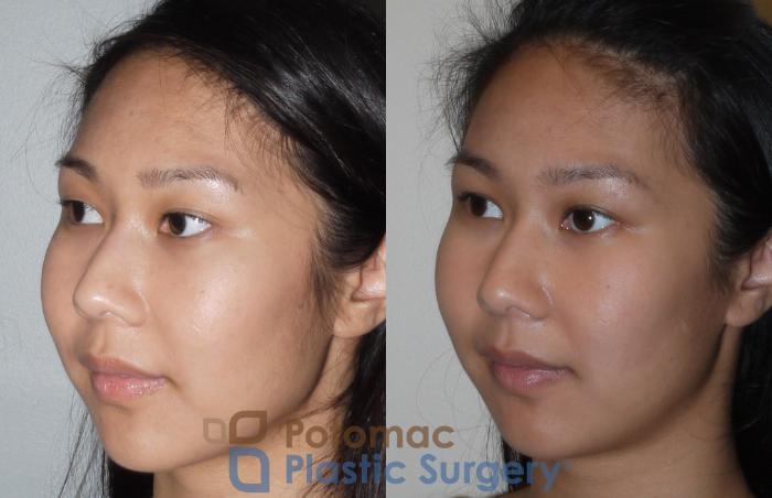 Before & After Asian Eyelid Surgery Case 109 Left Oblique View in Washington DC & Arlington , DC