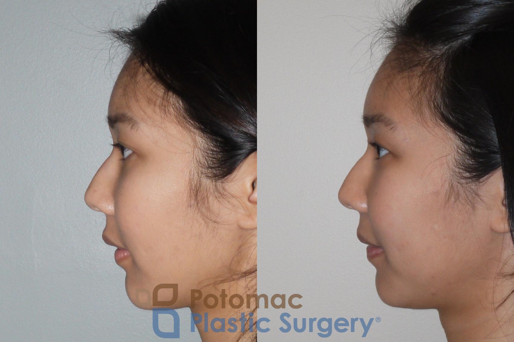 Before & After Asian Eyelid Surgery Case 109 Left Side View in Washington, DC