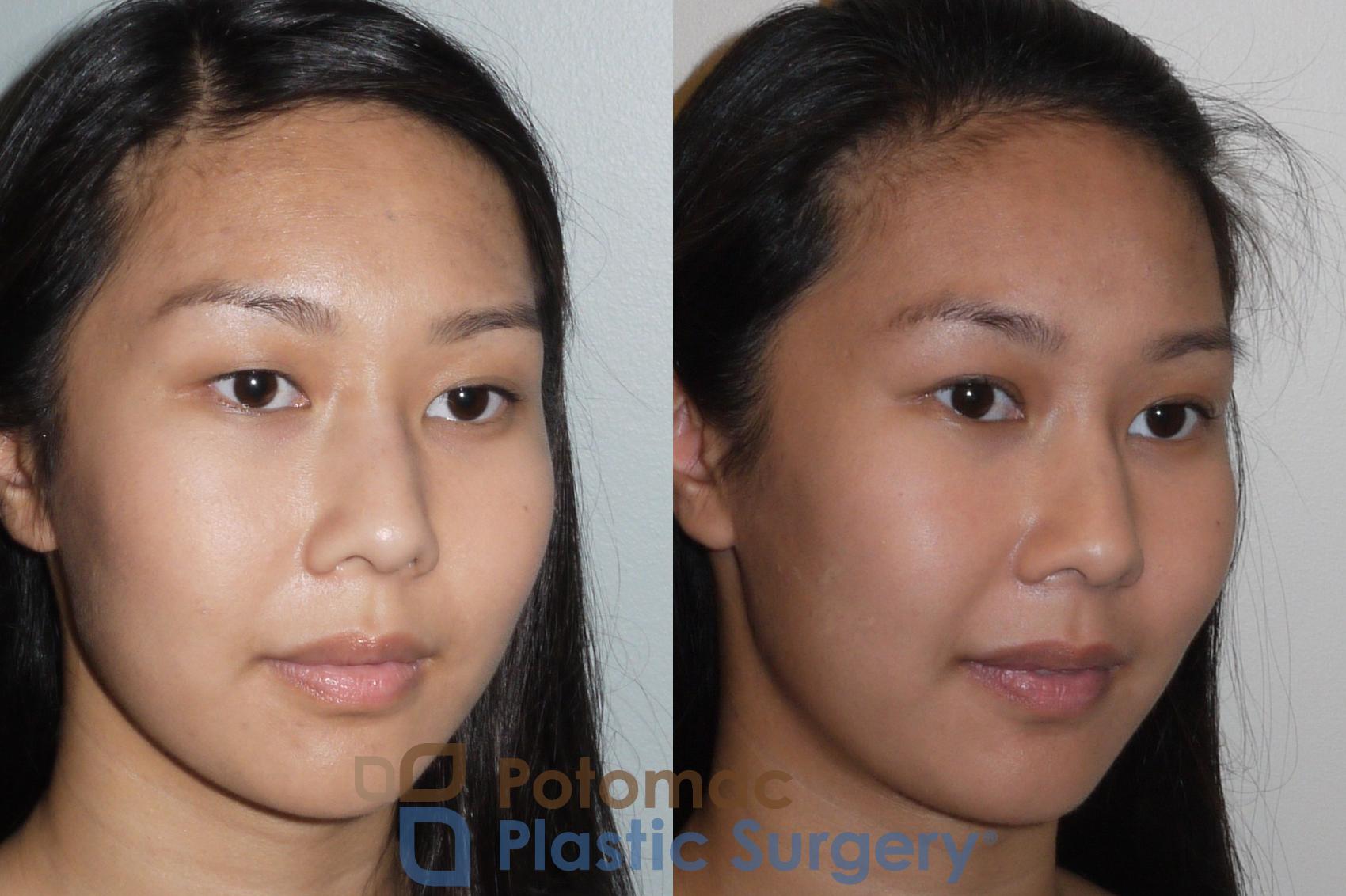Before & After Asian Eyelid Surgery Case 109 Right Oblique View in Washington, DC