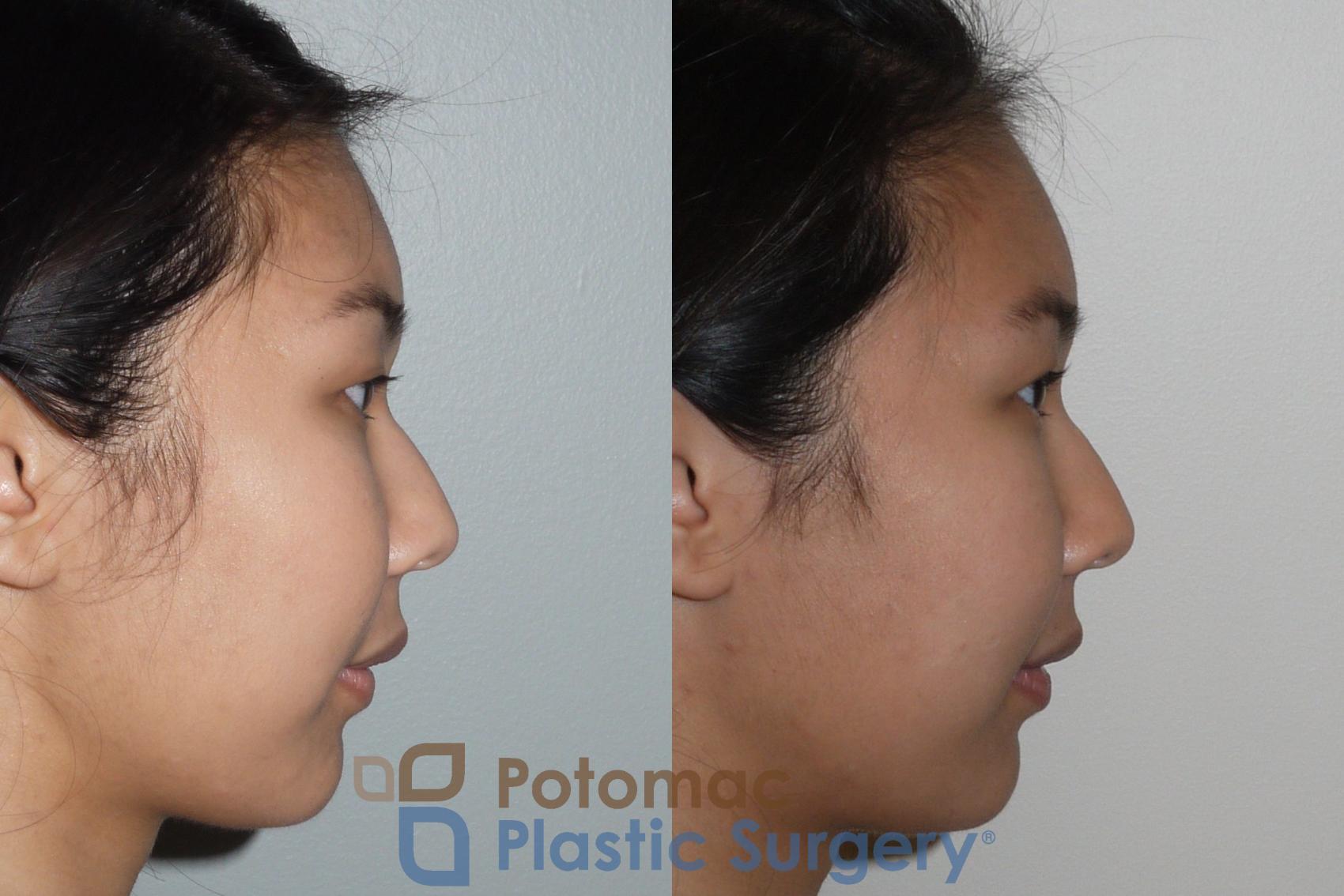 Before & After Blepharoplasty Case 109 Right Side View in Washington, DC