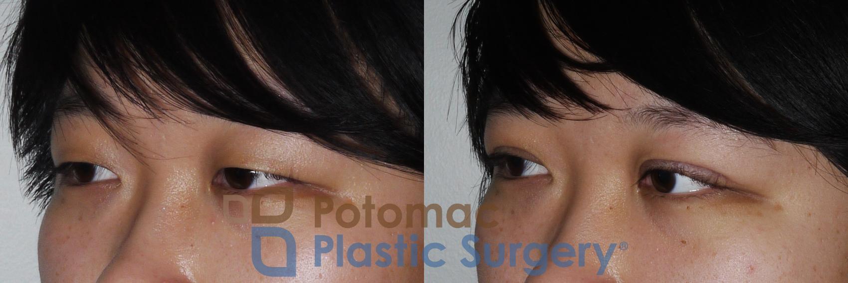 Before & After Asian Eyelid Surgery Case 159 Left Oblique View in Washington, DC