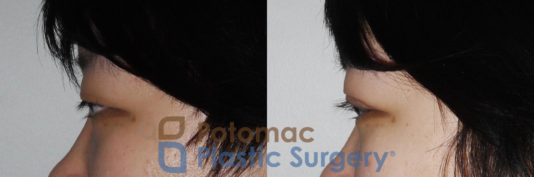 Before & After Asian Eyelid Surgery Case 159 Left Side View in Washington, DC