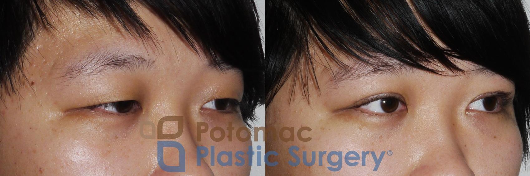 Before & After Asian Eyelid Surgery Case 159 Right Oblique View in Washington, DC