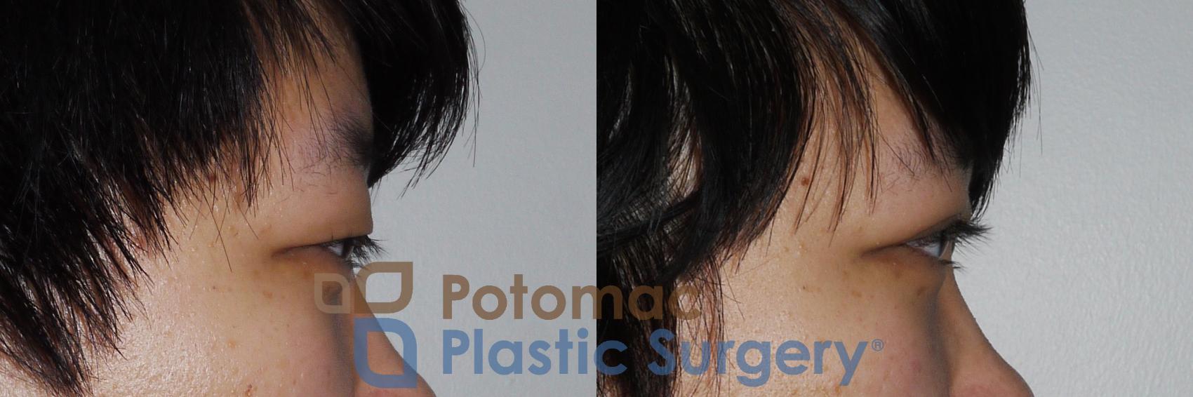 Before & After Blepharoplasty (Eyelid Surgery) Case 159 Right Side View in Washington DC & Arlington , DC
