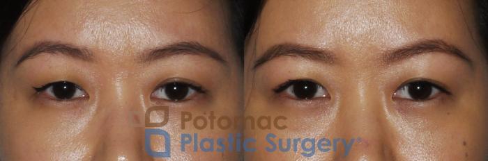 Before & After Asian Eyelid Surgery Case 163 Front View in Washington, DC
