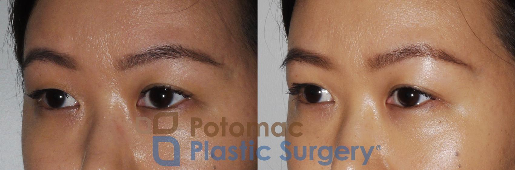 Before & After Asian Eyelid Surgery Case 163 Left Oblique View in Washington, DC