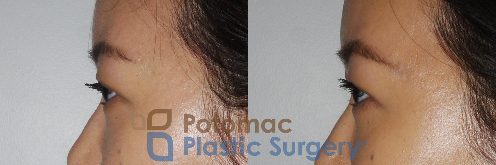 Before & After Asian Eyelid Surgery Case 163 Left Side View in Washington, DC