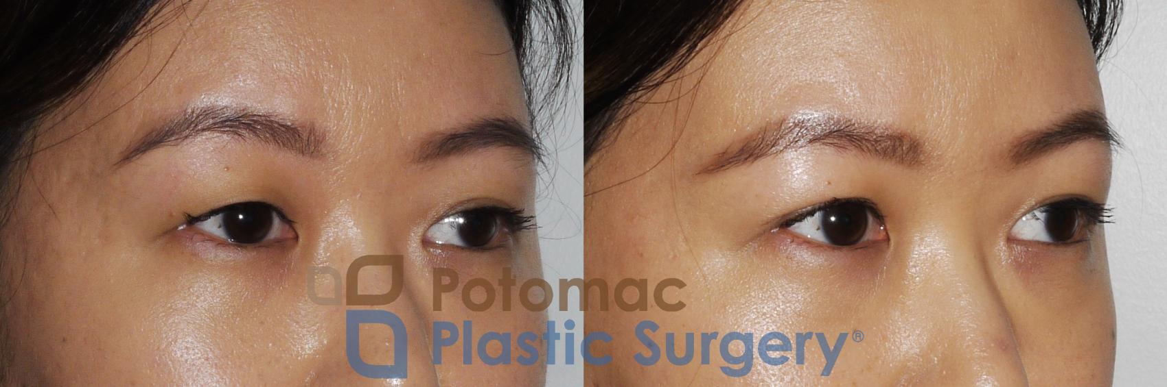Before & After Blepharoplasty (Eyelid Surgery) Case 163 Right Oblique View in Washington DC & Arlington , DC