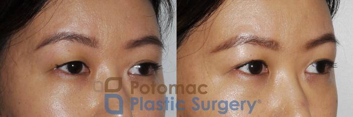 Before & After Asian Eyelid Surgery Case 163 Right Oblique View in Washington, DC