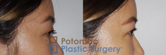 Before & After Asian Eyelid Surgery Case 163 Right Side View in Washington, DC