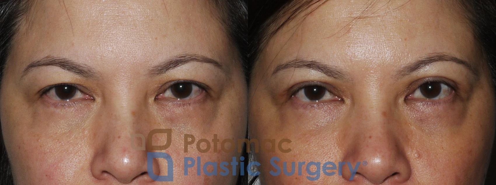 Before & After Asian Eyelid Surgery Case 170 Front Close-Up View #1 View in Washington, DC