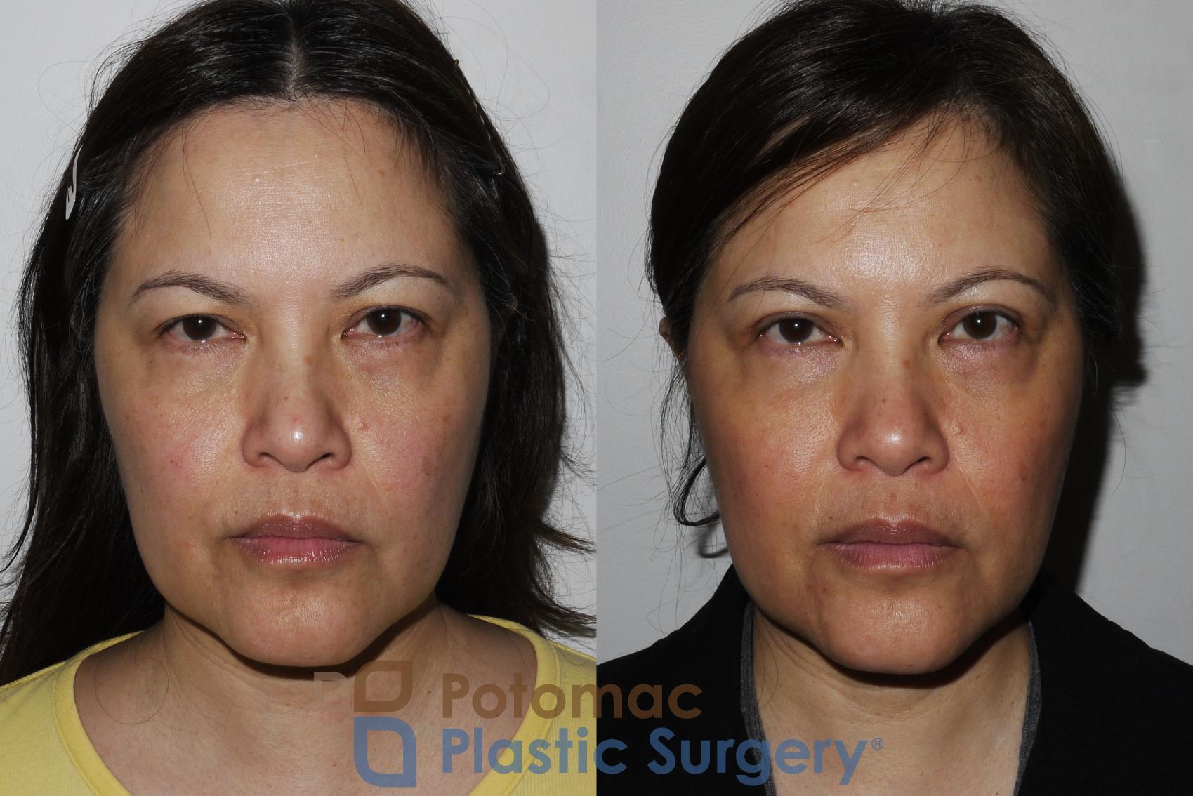 Before & After Asian Eyelid Surgery Case 170 Front View in Washington, DC