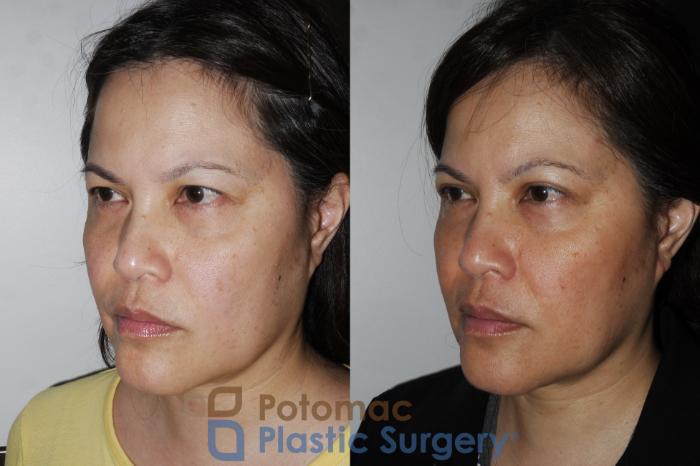 Before & After Blepharoplasty Case 170 Left Oblique View in Washington DC & Arlington , DC