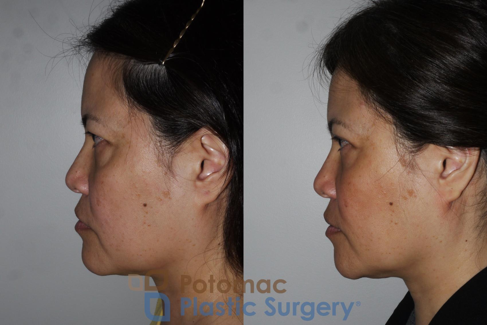 Before & After Asian Eyelid Surgery Case 170 Left Side View in Washington, DC